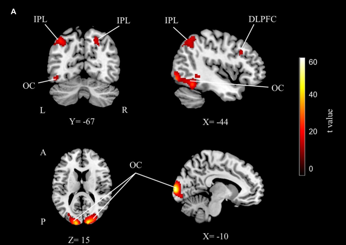 yayınlar-Children With Dyscalculia Show Hippocampal Hyperactivity During Symbolic Number Perception-1