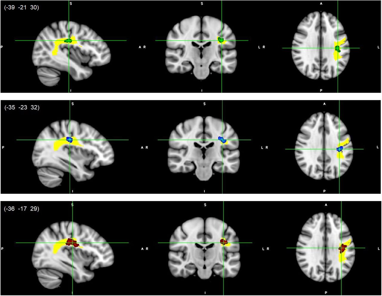 paper- structural brain connectivity dyscalculia-1
