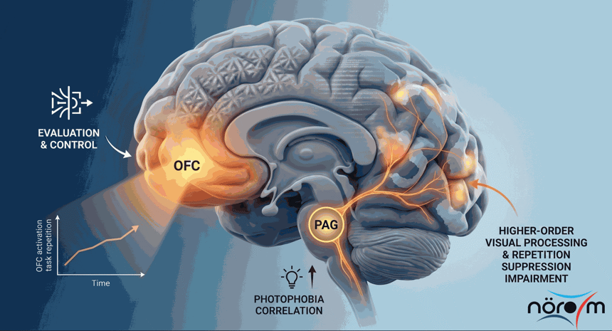 Mental Fatigue and Migraine: Changes in Visual Processing