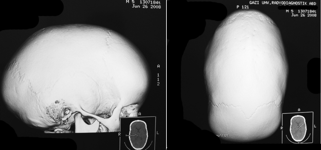 Cocuk Beyin Cerrahisi Kraniyofasiyal Bas Ve Yuz Anomalileri